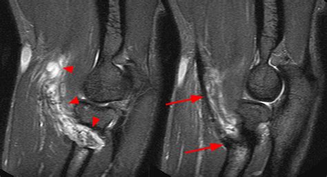 biceps tendon tear test|mri for biceps tendon rupture.